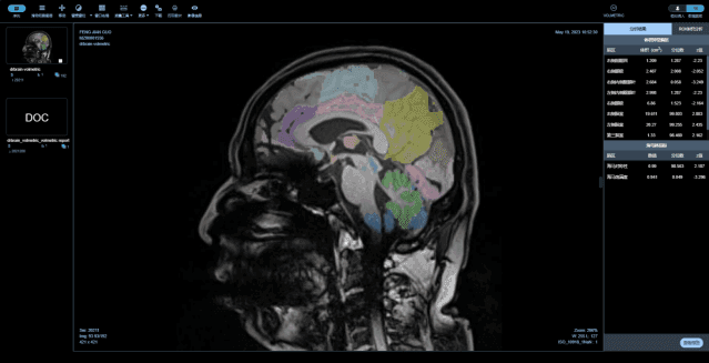 ซอฟต์แวร์ AI ช่วยวินิจฉัยโรคอัลไซเมอร์จากภาพ MRI ใบแรกของโลกที่ได้รับการอนุมัติ NMPA Class III